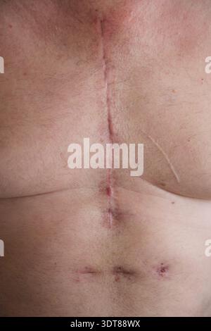cicatrice sul petto di un uomo dopo un intervento al cuore Foto Stock
