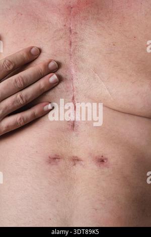 cicatrice sul petto di un uomo dopo un intervento al cuore Foto Stock