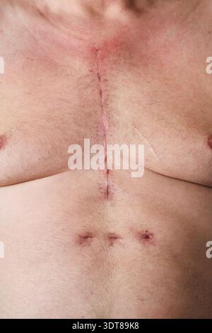 cicatrice sul petto di un uomo dopo un intervento al cuore Foto Stock