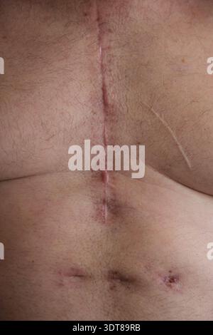 cicatrice sul petto di un uomo dopo un intervento al cuore Foto Stock
