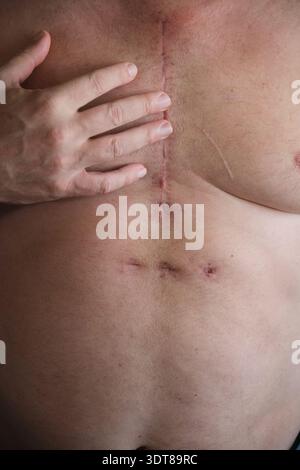 cicatrice sul petto di un uomo dopo un intervento al cuore Foto Stock