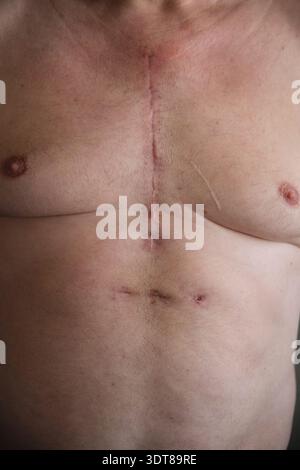 cicatrice sul petto di un uomo dopo un intervento al cuore Foto Stock