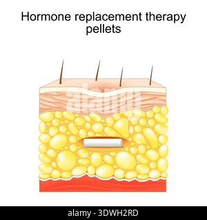 Pellet per terapia ormonale sostitutiva. Sezione trasversale di una pelle umana con pellet ormonale nello strato di grasso. Illustrazione vettoriale. Diagramma medico Illustrazione Vettoriale