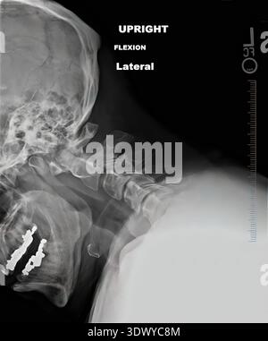 Radiografia del cranio umano e della colonna vertebrale che mostra la flessione della colonna cervicale, la struttura ossea e gli impianti dentali, visualizzando l'imaging diagnostico medico per un Foto Stock