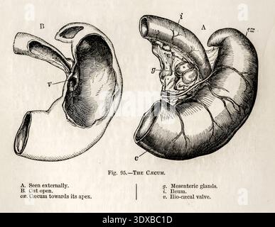 Incisione anatomica d'epoca del cumo e della valvola ileocecale, viste esterne e aperte per uso medico ed educativo. Di Mivart, St. George Jackson, 1881 Foto Stock