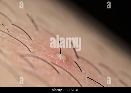 Primo piano di un Pimple sulla pelle umana Foto Stock