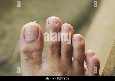 La pelle dell'alluce si è staccata a causa della secchezza. Foto Stock