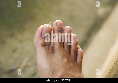 La pelle dell'alluce si è staccata a causa della secchezza. Foto Stock