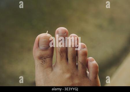 La pelle dell'alluce si è staccata a causa della secchezza. Foto Stock