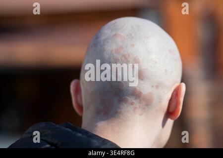Vista posteriore dell'uomo calvo con psoriasi sul cuoio capelluto. Eruzione cutanea e infiammazione della testa. Condizione medica, malattia autoimmune, dermatologia e salute probl Foto Stock