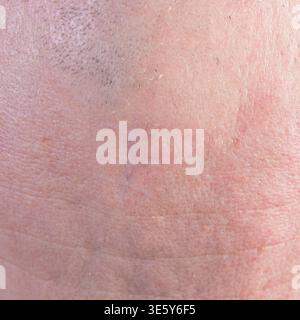 Primo piano della cicatrice chirurgica sulla pelle umana che mostra il processo di guarigione e concetto di recupero medico Foto Stock
