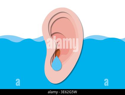 Illustrazione concettuale dell'orecchio del nuotatore. L'orecchio del nuotatore, noto anche come otite esterna, è un'infezione del canale uditivo esterno più comunemente causata da batteri che entrano nell'orecchio attraverso l'esposizione prolungata all'acqua. Provoca sintomi tra cui dolore alle orecchie, prurito, arrossamento e perdita temporanea dell'udito. È più comune nei nuotatori, ma può anche derivare da danni al canale uditivo causati da boccioli di cotone o corpi estranei. Il trattamento include gocce di orecchie antibiotiche o antifungine e mantiene l'orecchio asciutto durante il recupero. Foto Stock