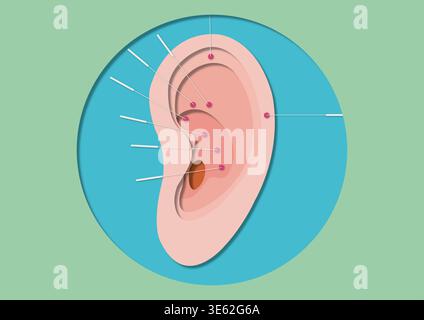 Agopuntura auricolare, illustrazione concettuale. Foto Stock
