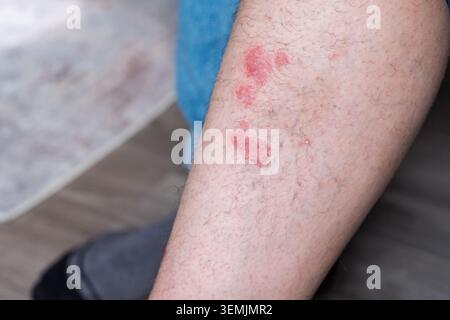Primo piano di macchie di psoriasi su una gamba umana, che mostrano lesioni cutanee rosse e squamose sull'arto inferiore in un ambiente domestico Foto Stock