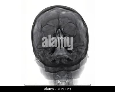Radiografia frontale trasparente del cranio umano che mostra l'anatomia ossea dettagliata per la valutazione clinica e la formazione. Foto Stock