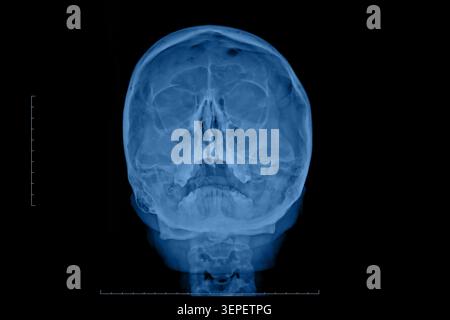 Immagine a raggi X frontale che mostra l'anatomia dettagliata del cranio per riferimento medico e progetti educativi. Foto Stock