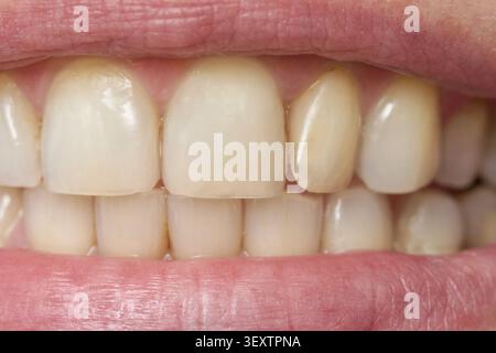 Denti anteriori superiori leggermente usurati ma allineati in sorriso Close Up bocca che mostra colore smalto naturale e margini sani di gomma. Foto Stock