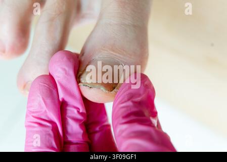 Prima di un medico che tratta un'unghia danneggiata su un alluce con unghia infetta visibile. Un medico preoccupato che tiene l'alluce ferito esamina la dolorosa lesione dell'unghia in una clinica di podologia sterile. Foto Stock