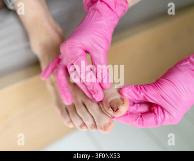 Visto dall'alto, un podologo con guanto rosa valuta una lesione all'unghia e un'unghia danneggiata sugli alluci. Uno specialista solleva delicatamente l'alluce esaminando l'unghia ferita e la pelle su un tavolo sterile in una clinica di podologia. Foto Stock
