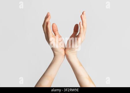 Malattia cronica della pelle. Mani femminili con macchie di vitiligo Foto Stock
