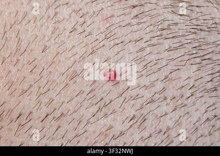 Un angioma rubino sul cuoio capelluto di un uomo con un taglio di capelli corto. Primo piano. Foto Stock