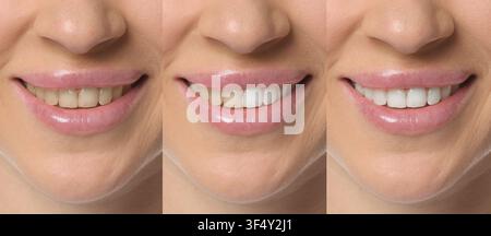 Collage che mostra una donna sorridente prima e dopo lo sbiancamento dei denti, primo piano Foto Stock