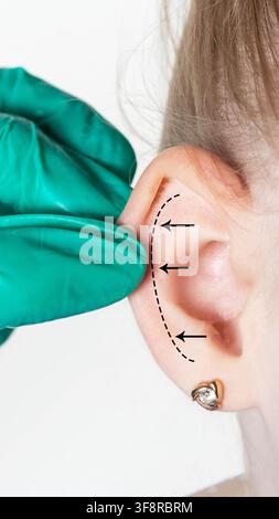 Immagine in primo piano della mano di un medico in guanto verde sterile che prepara l'orecchio di un giovane paziente per un'otoplastica, dimostrando le linee di incisione proposte e la direzione Foto Stock