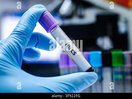 Tubo per il prelievo di sangue per l'analisi del test Hb CS. Foto Stock