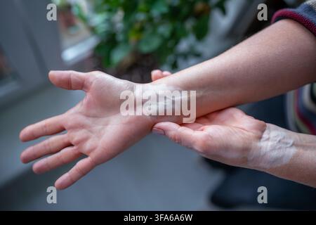 Donna con vitiligo su mani e polsi, macchie depigmentate naturali e contrasto di pigmentazione cutanea Foto Stock