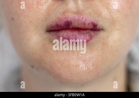 Labbra vere di donne livide dopo iniezione di aumento delle labbra con acido ialuronico in primo piano, complicazioni ed ematomi dopo un'iniezione di bellezza con ialuronano Foto Stock