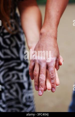 Mani di una persona con vitiligo e del partner che si tengono strette, rappresentando sostegno, accettazione, diversità e relazioni. Foto Stock