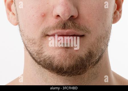 Pelle del viso soggetta all'acne di un giovane uomo, primo piano Foto Stock