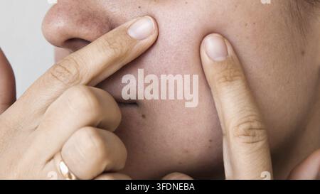 Estremo primo piano della guancia femminile premuta dalle dita, pori ingranditi e arrossamento facciale, condizione della pelle, acne e concetto di cura dermatologica cosmetica Foto Stock