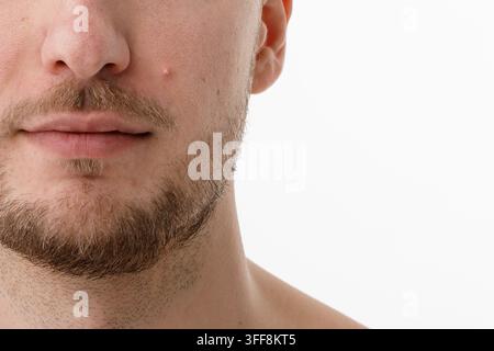 Primo piano della pelle umana con acne e imperfezioni Foto Stock