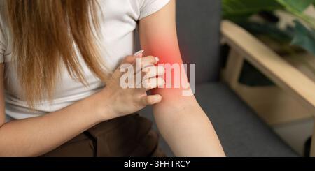 Irritazione cutanea. Giovane donna che applica crema al braccio irritato. Foto Stock