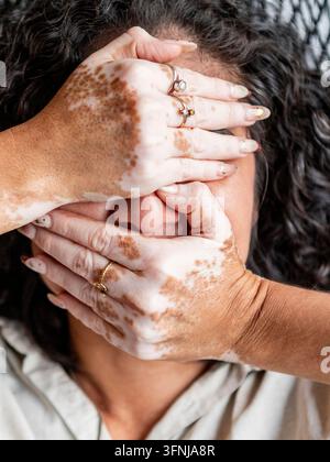 Ritratto ravvicinato di una donna con vitiligine che copre il viso con le mani, evidenziando le macchie di pelle depigmentate, l'auto-accettazione, la positività del corpo e Foto Stock