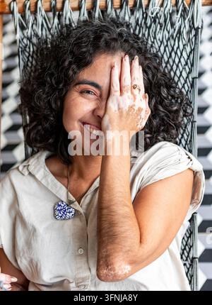 Ritratto di una donna sorridente con vitiligo che riposa su una sedia intrecciata, copre giocosamente un occhio con la mano mentre abbraccia la diversità naturale della pelle Foto Stock