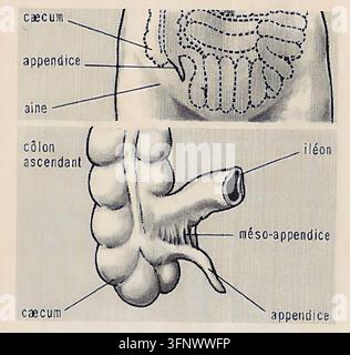 Un'illustrazione anatomica da un dizionario francese, che etichetta il cieco, il colon ascendente, l'ileo, l'appendice, il mesoappendice e la regione dell'inguine. Il diagramma medico vintage presenta l'appendice e le strutture intestinali adiacenti con annotazioni francesi in stile manoscritto. Foto Stock