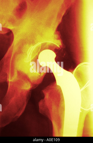 Articolazione artificiale dell'Anca X Ray Foto Stock