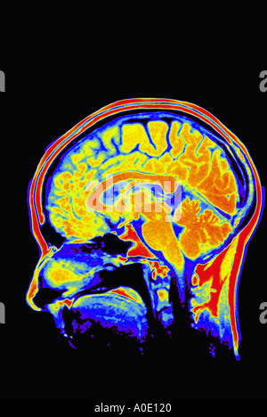 Esplorazione di MRI del cervello Foto Stock