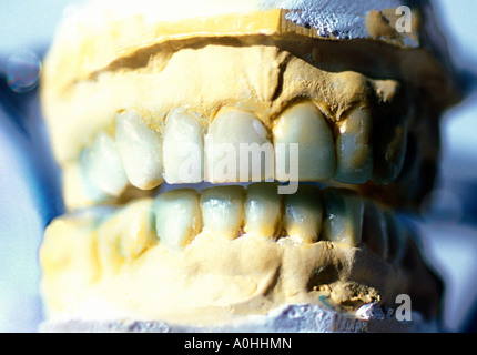 Closeup della muffa del dentista dei denti della persona umana Foto Stock