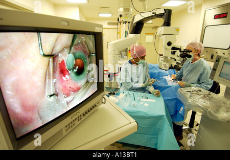 Operazione di cataratta visto in stretta fino sul teatro operativo schermo con donna medico e infermiere dietro. Foto Stock