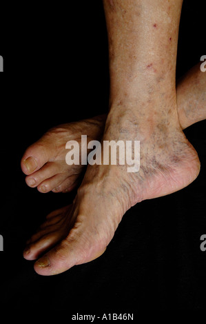 Piedi di anziani con trombosi venosa profonda TVP Foto Stock