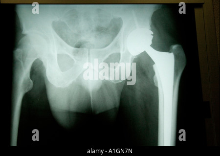 X-ray totale di anca destra artroplastica anca Foto Stock