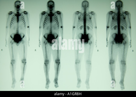 Osso nucleari scansione, corpo pieno a tre fasi, Foto Stock