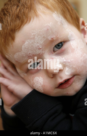 Bambino con la varicella macchie sul viso e calamina lozione Foto Stock