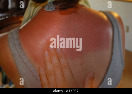 Mano sfregamento in crema su una schiena bruciata dal sole di una donna Foto Stock