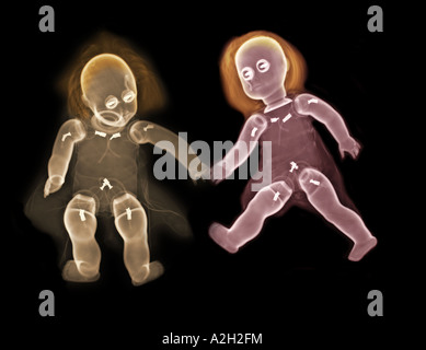 Colorizzato xray di un bambino bambole Foto Stock