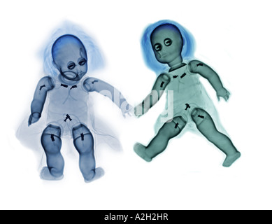 Colorizzato xray di un bambino bambole Foto Stock