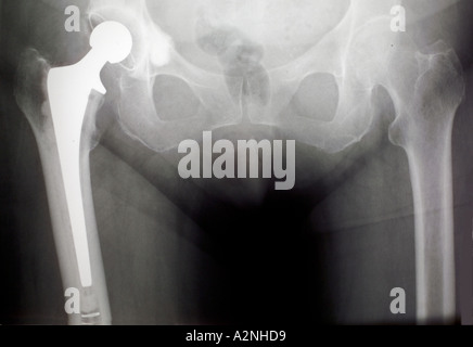 Sostituzione dell'anca - la radiografia dopo intervento chirurgico Foto Stock